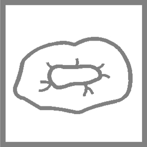 Ausbohren alter Füllungen